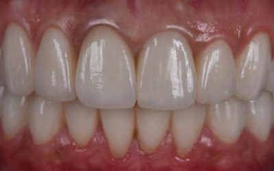 Клей для зубних коронок: правила використання та основні особливості