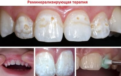Ремінералізація зубів: як проводиться процедура, препарати, відгуки