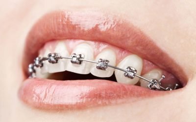 Ретенційний період ортодонтичного лікування після зняття брекетів