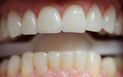 Догляд за зубами з металокераміки: засоби і методи чищення протезів