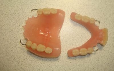 Знімні протези для зубів: які краще і як їх вибрати?