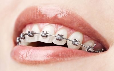Що ставлять на зуби після брекетів: що носять після зняття конструкції?