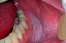 Виразка на внутрішній стороні губи: причини появи та методи лікування