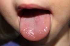 На язиці червона пляма: причини, методи діагностики та лікування