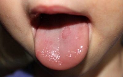 На язиці червона пляма: причини, методи діагностики та лікування