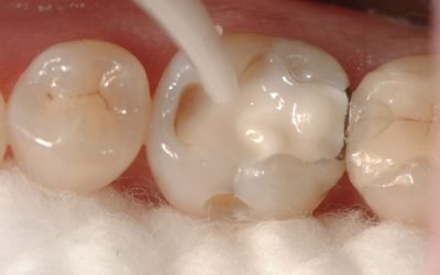 Композитні матеріали в стоматології: призначення та різновиди