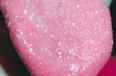 Білі точки на язиці: причини появи й способи лікування