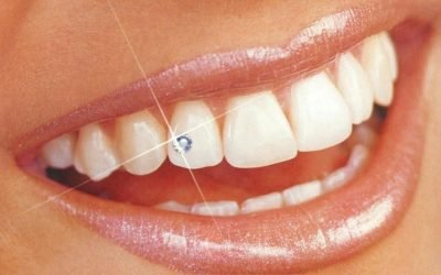 Скайси на зуби: різновиди прикрас, особливості догляду
