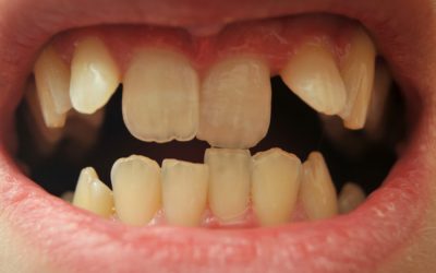 Як вирівняти зуби без брекетів: альтернативні методи корекції прикусу