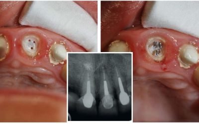 Нарощування зуба на корінь: методи відновлення