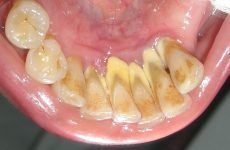 Боляче видаляти зубний камінь: види і необхідність очищення