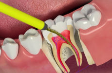 Депульпирование зуба перед протезуванням: показання та протипоказання