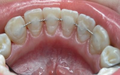 Шинування зубів: особливості проведення процедур, показання та відгуки