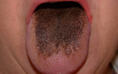 Коричневий наліт на язиці у дорослих: причини появи та методи діагностики