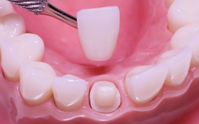 Коронки на зуби: різновиди, переваги і недоліки