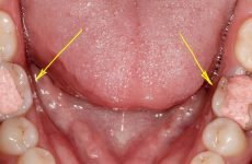 Болить зуб під тимчасовою пломбою: причини і що робити?