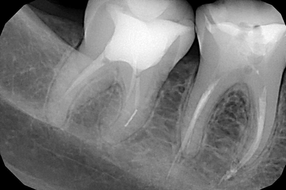 Трещина болит. Перфорация корневого канала рентген. Перфорация корня зуба на рентгене. Отлом эндодонтического инструмента в канале корня.
