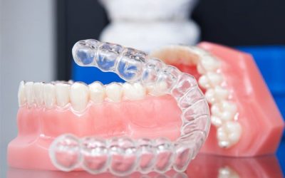 Капа для зубів: особливості застосування, види, плюси і мінуси