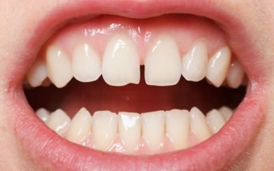 Щілина між зубами (Діастема): різновиди та методи корекції дефекту