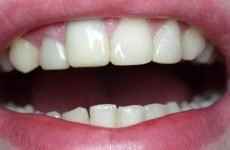 Реставрація зубів: методи та етапи процедури, відгуки пацієнтів