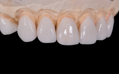 Порцелянові зуби (коронки): виготовлення, переваги і недоліки у використанні