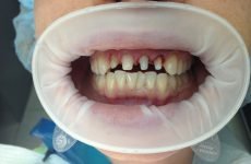 Підпилювання зубів: особливості процедури, показання та відгуки