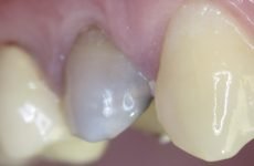 Відновлення зубної емалі: причини руйнування та методи відновлення