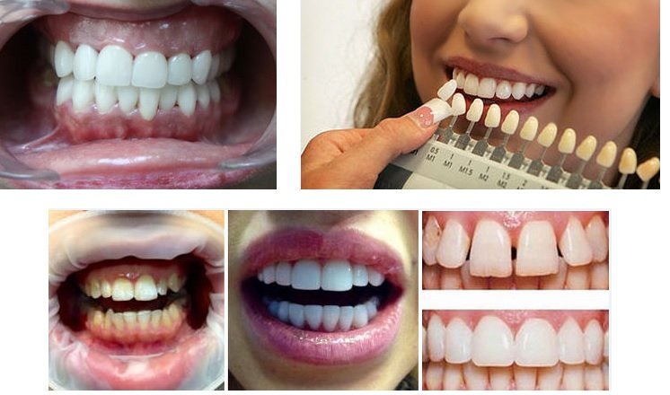 Сколько делают зубы