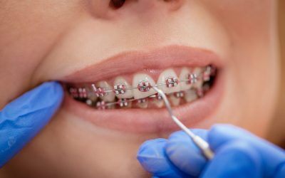 Догляд за брекетами: методи очистки, вибір засобів, рекомендації стоматологів