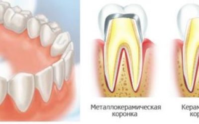 Який лікар ставить коронки на зуби в стоматологічних клініках?