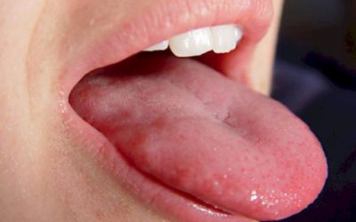 Болить кінчик язика: причини та способи лікування