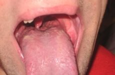 Болить корінь язика: причини захворювання, діагностика і методи лікування болю