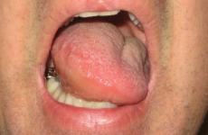 Опух язик: причини, можливі ускладнення і методи лікування