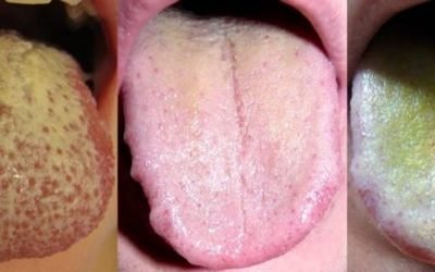 Жовтий наліт на язиці у дорослих: причини, симптоми і способи лікування