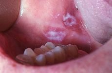 Лейкоплакія порожнини рота: форми захворювання, симптоми і методи лікування