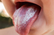 Наліт на язиці у дитини: причини появи та методи лікування