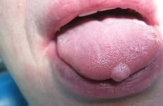 На язиці нарости: причини появи та методи лікування