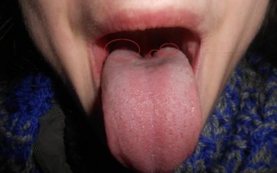Запалення кореня язика, причини і методи лікування