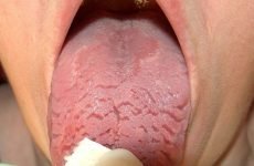 Тріщини на язиці: причини виникнення та методи лікування