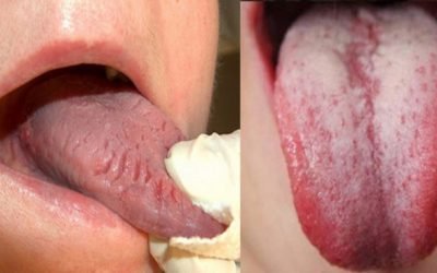 Болить язик: причини, місця локалізації болю і методи лікування