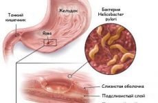 Основні симптоми виразкової хвороби шлунка і методика її лікування