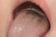 Чорний наліт на язиці у дитини: причини появи й способи лікування