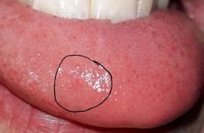 На язиці болить прищик: причини появи й способи лікування