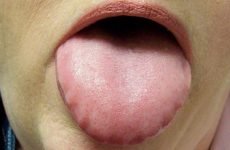 Відбитки зубів по краях язика: причини появи