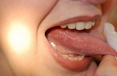 Болять бічні ділянки язика: причини і методи лікування