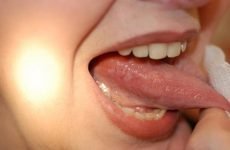 Кровоточить язик: причини і методи лікування