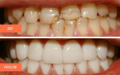 Вініри на зуби: різновиди, установка, переваги і недоліки