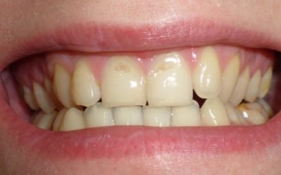Ерозія емалі зубів: причини, методи діагностики та лікування