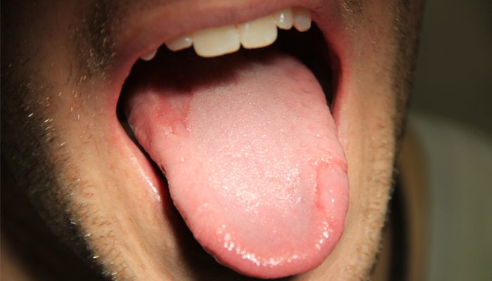 Діагностика гастриту через вигляд язика