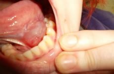 Болячка під язиком: причини виникнення, методи діагностики та лікування